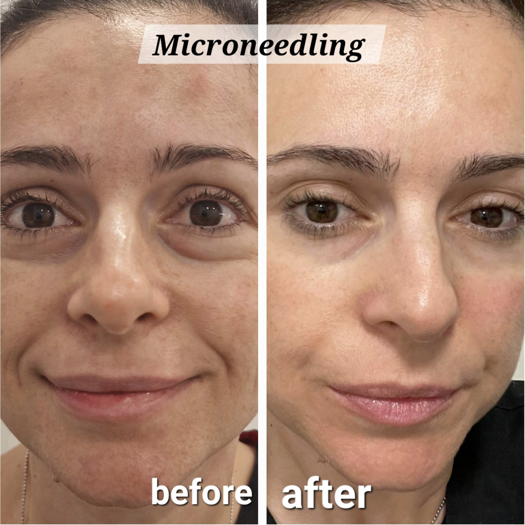 Microneedling treatment result at Prisca's Skincare Hounslow