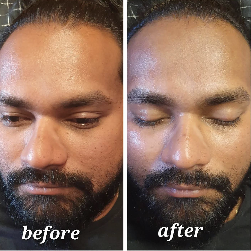 Skin treatment result at Prisca's Skincare